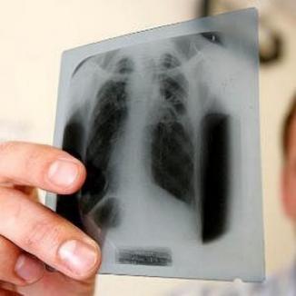 Tuberculoza 
